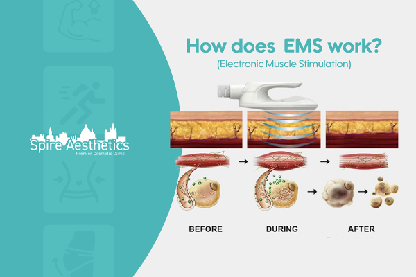 EMS treatment for post pregnancy weight loss treatment Portland Bill