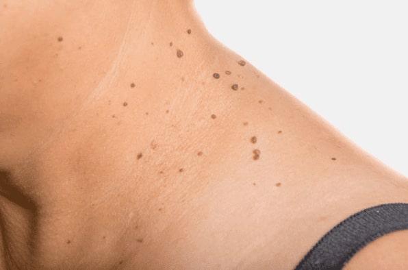 Are you looking for easy skin tag removal Portland Bill - then contact Spire today!