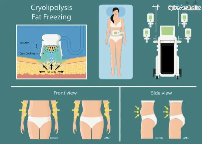 Fat freezing treatment Portland Bill benefits for competitions to remove stubborn fat deposits.