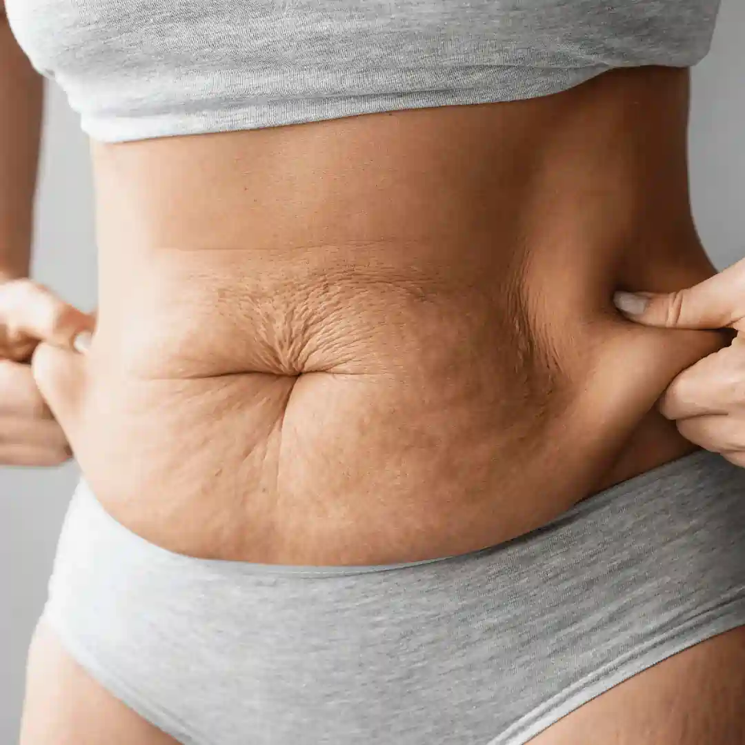 Is It Normal to Have Loose Skin After Pregnancy Portland Bill?